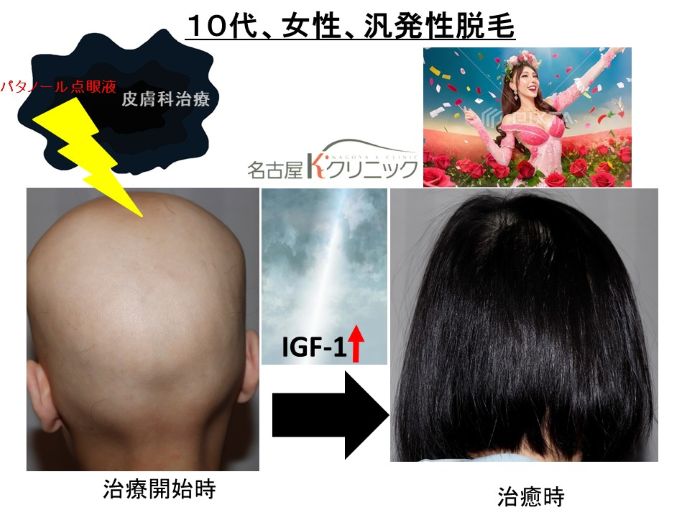 円形脱毛症　病院